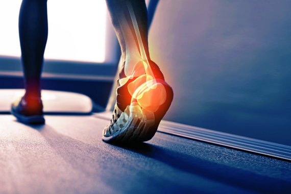 How to Deal With Plantar Fasciitis